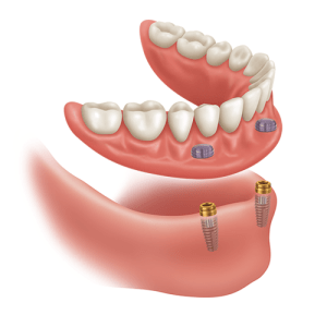 Tooth-Supported Overdenture