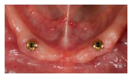 Tooth-Supported Overdenture over head view before insertion