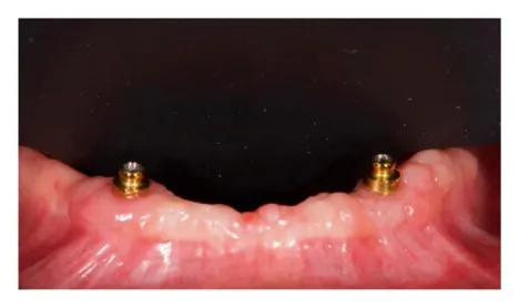 Tooth-Supported Overdenture over front view before insertion
