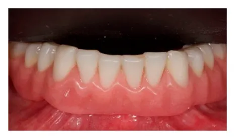 Tooth-Supported Overdenture completed