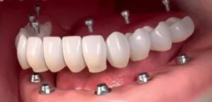 Fixed Full-Arch (All-On-X) Prosthesis animation/instruction