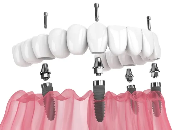 Fixed Full-Arch (All-On-X) Prosthesis animation alternate view
