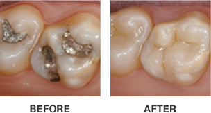 Before and after of same day crown